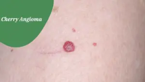 Natural Homeopathic Treatment for Cherry Angioma