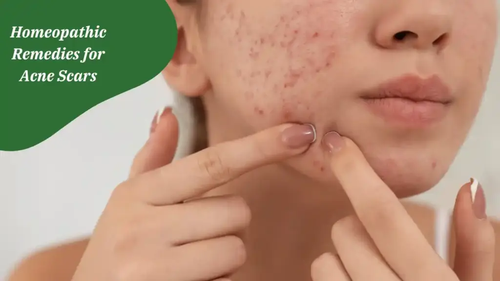 Homeopathic Remedies for Acne Scars