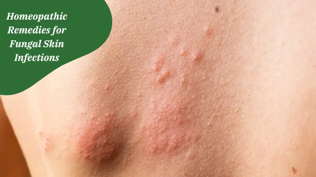 Homeopathic Remedies for Fungal Skin Infections