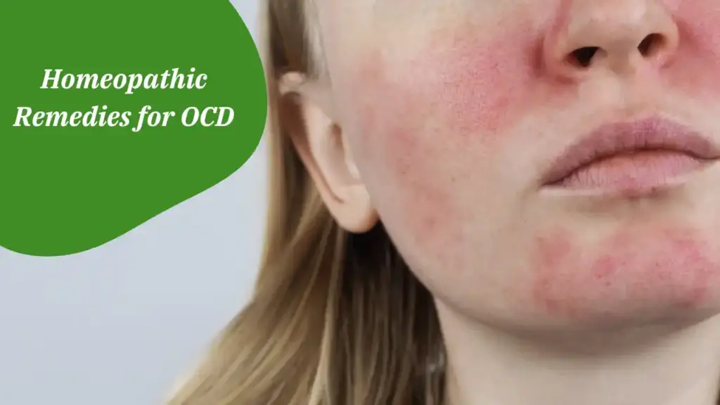 Homeopathic Remedies for Rosacea