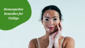 Homeopathic Remedies for Vitiligo