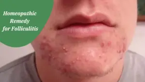 Homeopathic Remedy for Folliculitis A Holistic Approach to Skin Health