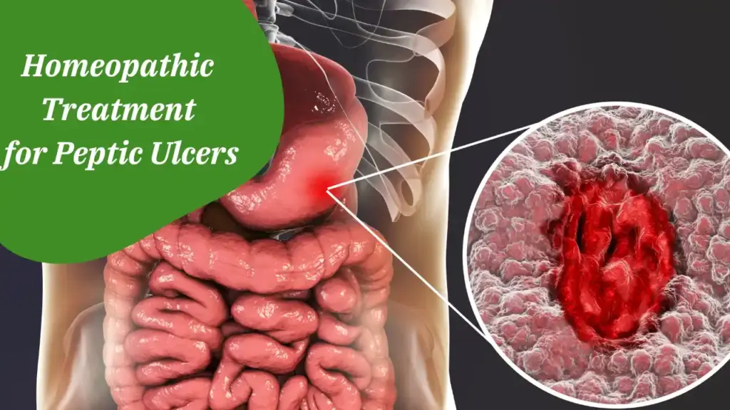 Homeopathic Treatment for Peptic Ulcers